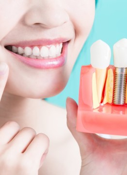 Классическая имплантация зубов