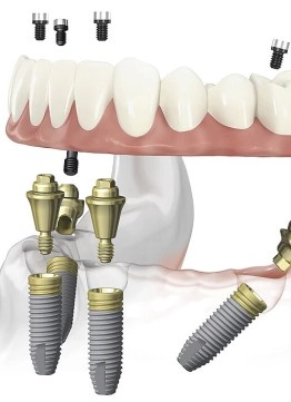 Имплантация зубов All-on-4