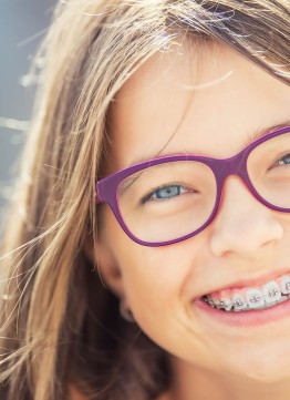 Металлические брекеты