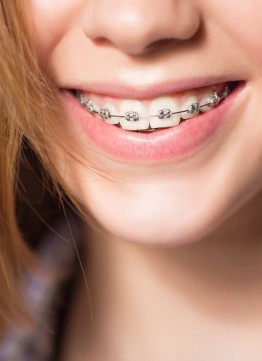 Лигатурные брекеты